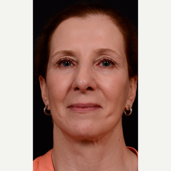 55-64 year old woman treated with Facelift after 3663569