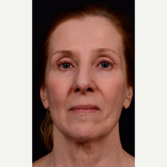 55-64 year old woman treated with Facelift before 3663569