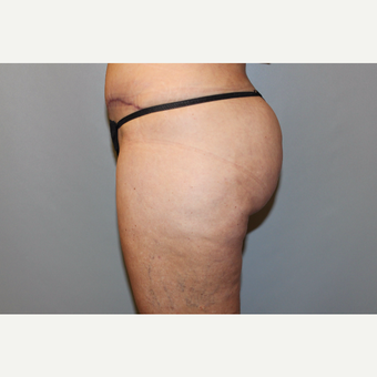 45-54 year old woman treated with Liposuction after 3588270