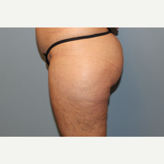 45-54 year old woman treated with Liposuction before 3588270