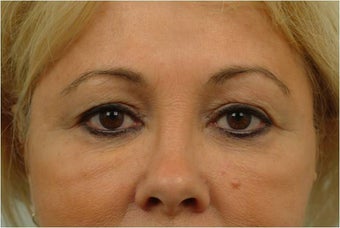 Upper and Lower Blepharoplasty before 386628