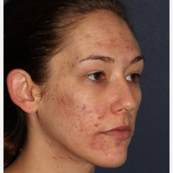 26 year old woman treated with Fraxel Repair 1706521