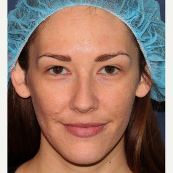 26 year old woman treated with Fraxel Repair after 1706521