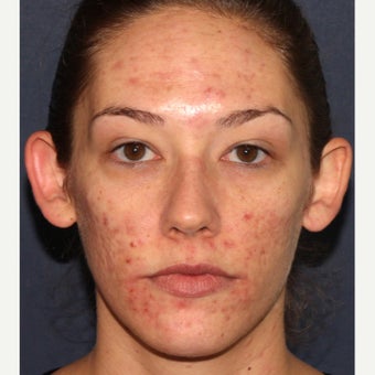 26 year old woman treated with Fraxel Repair before 1706521
