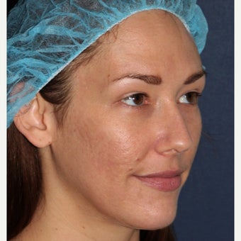26 year old woman treated with Fraxel Repair 1706521