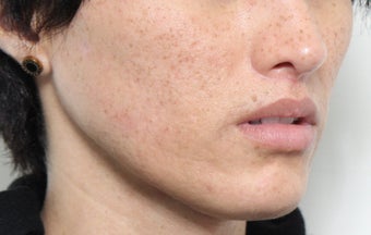 Lip Lift Procedure 2566381