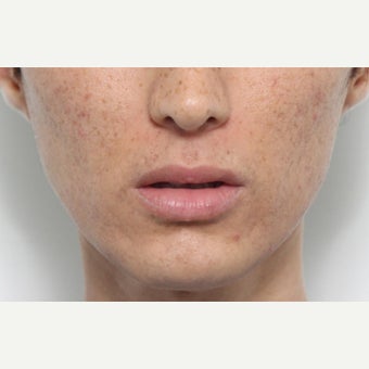 Lip Lift Procedure before 2566381