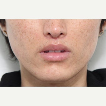 Lip Lift Procedure after 2566381
