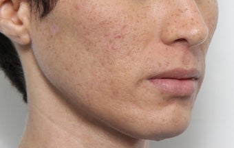 Lip Lift Procedure 2566381