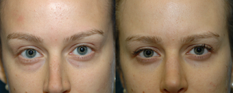 25 year old woman with lower blepharoplasty with fat repositioning before 1291830
