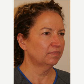 45-54 year old woman treated with Facelift before 3419940