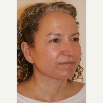 45-54 year old woman treated with Facelift after 3419940