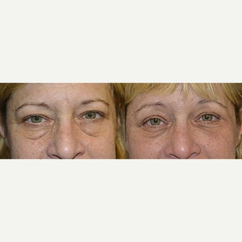 55-64 year old woman treated with Eye Bags Treatment before 2654890