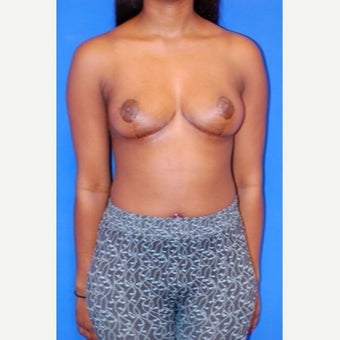 18-24 year old woman treated with Breast Reduction after 2664422