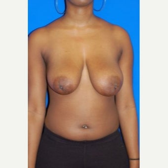 18-24 year old woman treated with Breast Reduction before 2664422