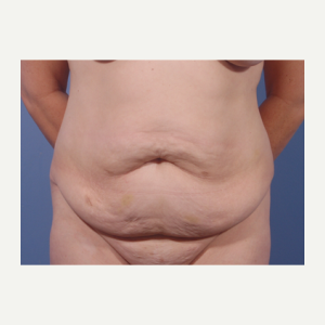 45-54 year old woman treated with Tummy Tuck before 3711674