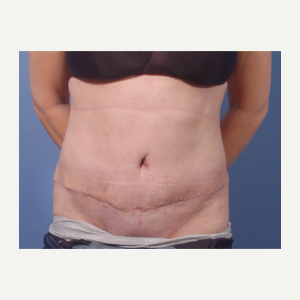 45-54 year old woman treated with Tummy Tuck after 3711674