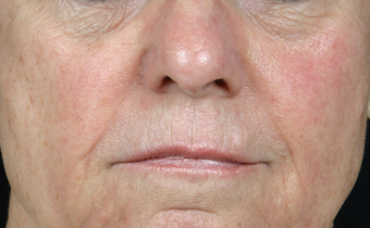 Juvederm Ultra Plus after 296335