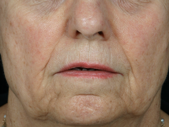 Juvederm Ultra Plus before 296335