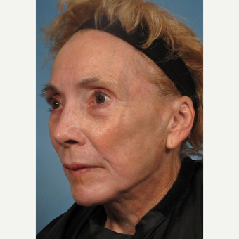75 and up year old woman treated with Facelift after 3176747