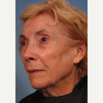 75 and up year old woman treated with Facelift before 3176747