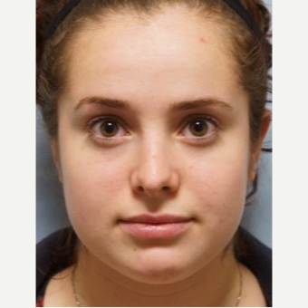 25-34 year old woman treated with Rhinoplasty after 3703428