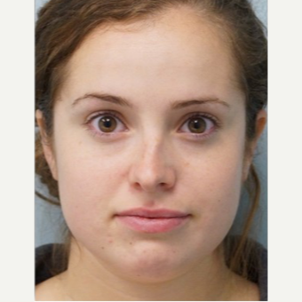 25-34 year old woman treated with Rhinoplasty before 3703428