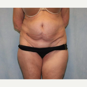 55-64 year old woman treated with Tummy Tuck before 3486948