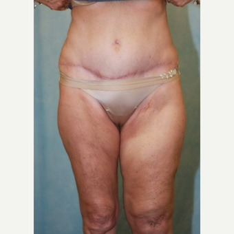 55-64 year old woman treated with Tummy Tuck after 3486948