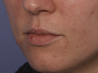 Perlane to Lips before 302264
