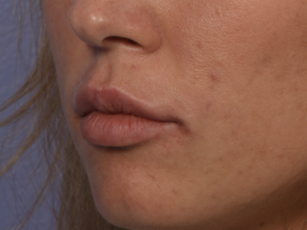 Perlane to Lips after 302264