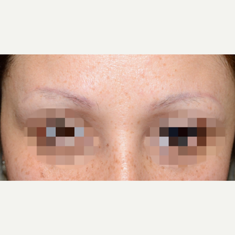 35-44 year old woman treated with Eyebrow Transplant before 3339294