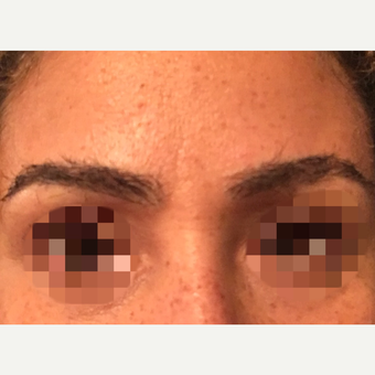 35-44 year old woman treated with Eyebrow Transplant after 3339294