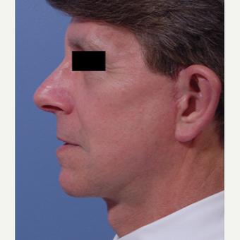 55-64 year old man treated with Ear Surgery after 3725159