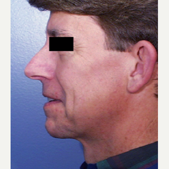 55-64 year old man treated with Ear Surgery before 3725159