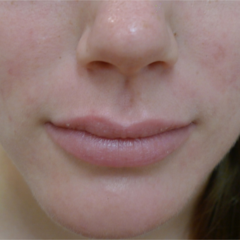 18-24 year old woman treated with Acne Treatment after 3670391