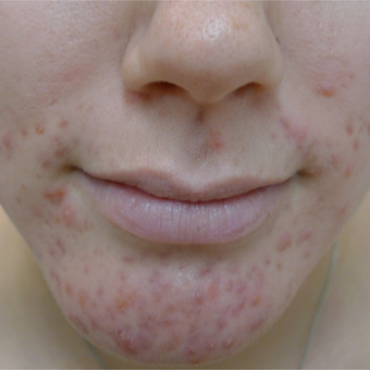 18-24 year old woman treated with Acne Treatment before 3670391