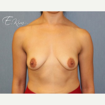 25-34 year old woman treated with Breast Lift with Implants before 3102583