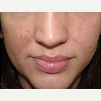 32 year old woman treated with InMode Fractora for acne scarring and discolorations from acne scarring after 1982759
