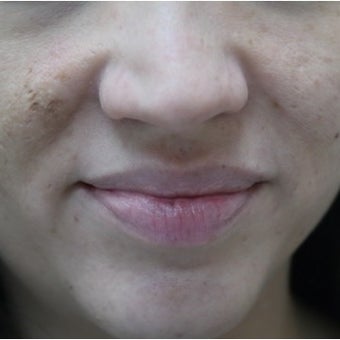 32 year old woman treated with InMode Fractora for acne scarring and discolorations from acne scarring before 1982759