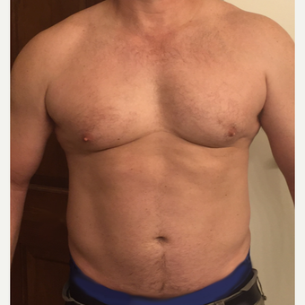 45-54 year old man treated with ThermiSmooth after 3452593