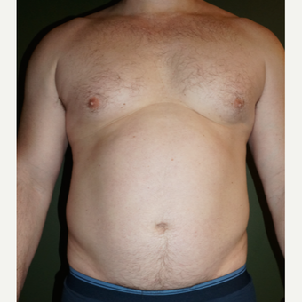 45-54 year old man treated with ThermiSmooth before 3452593