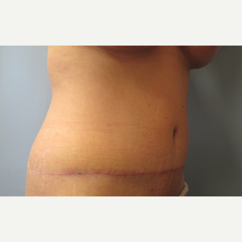 46 year old woman treated with Tummy Tuck and Liposuction after 3108195