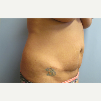46 year old woman treated with Tummy Tuck and Liposuction before 3108195