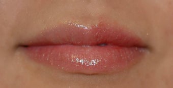 Juvederm in Lips after 871673