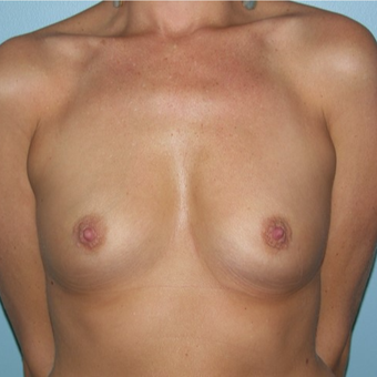 25-34 year old woman treated with Breast Augmentation before 3337276