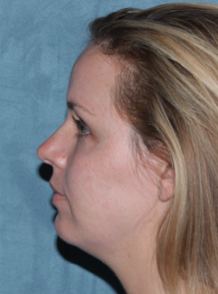 Fraxel Dual Laser Treatment after 1064716
