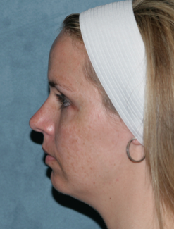 Fraxel Dual Laser Treatment before 1064716