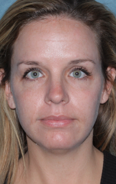 Fraxel Dual Laser Treatment 1064716