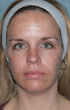Fraxel Dual Laser Treatment 1064716